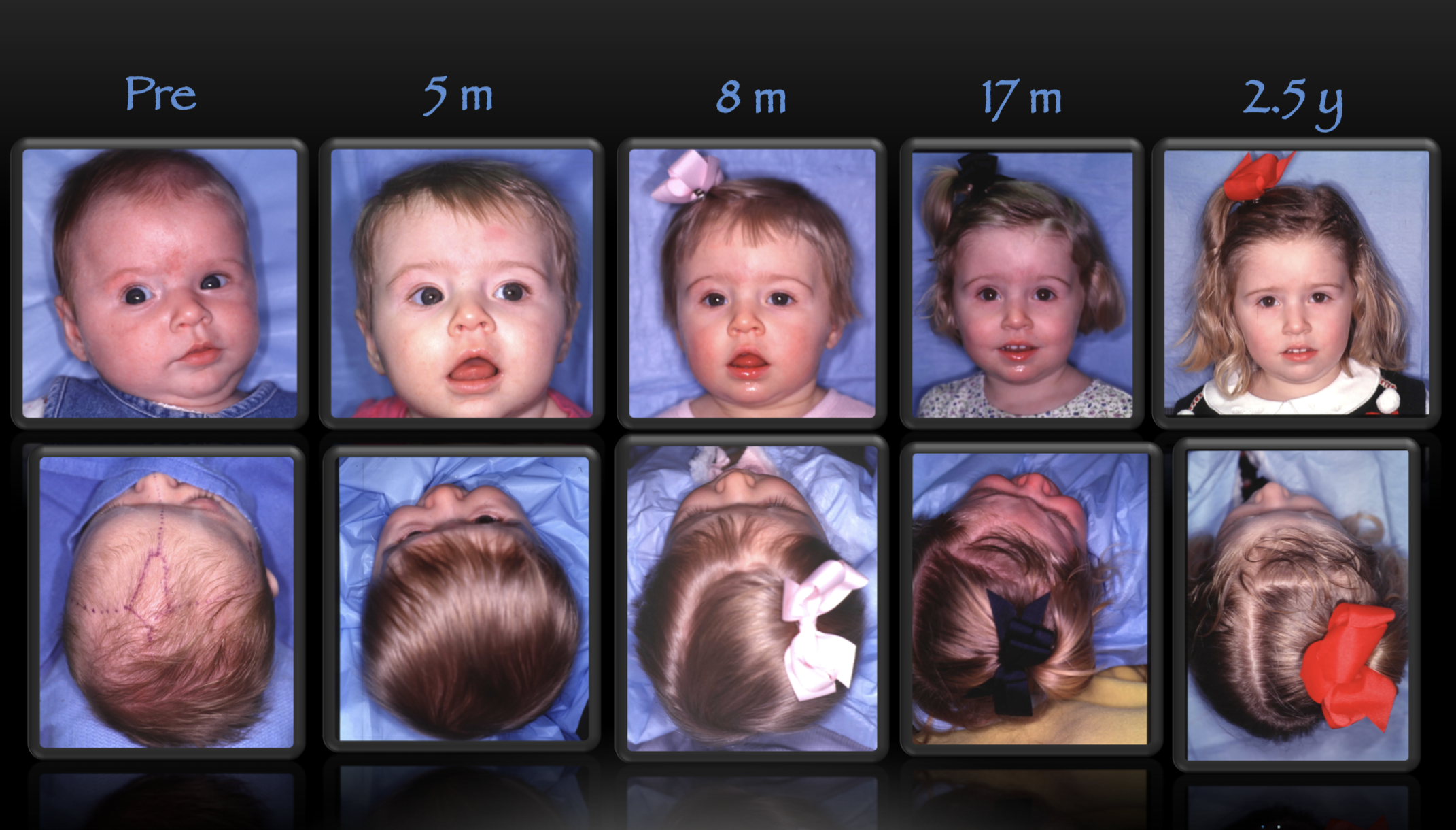 coronal craniosynostosis before and after